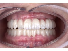 深圳高端种植牙工厂 义齿外贸定制服务 外贸出口图3